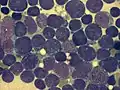 Bone marrow smear (large magnification) from a person with acute lymphoblastic leukemia