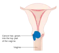 Stage 2A cervical cancer