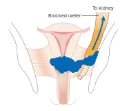 Stage 3B cervical cancer