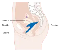 Stage 4A cervical cancer