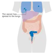 Stage 4B cervical cancer
