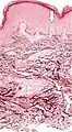 Histopathology of elastosis perforans serpiginosa: Degenerated elastic fibers and transepidermal perforating canals (arrow points at one of them)