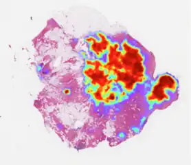 Breast cancer prediction by artificial intelligence on a whole-slide image, an emerging process in digital pathology.