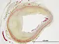 Movat's stain showing luminal stenosis in coronary artery atherosclerosis