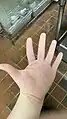 hand with minor chemical burns, recieved from a commercial grade dishwasher