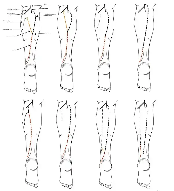 8 documented types of sural nerve formation