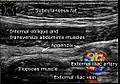 Abdominal ultrasound showing a normal appendix between the external iliac artery and the abdominal wall