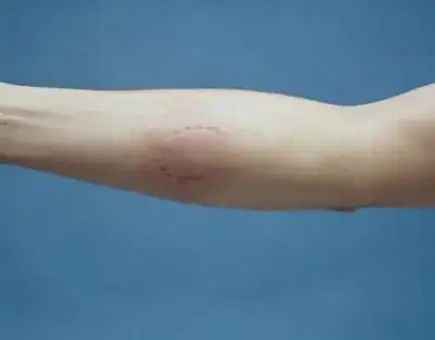 Human bite mark