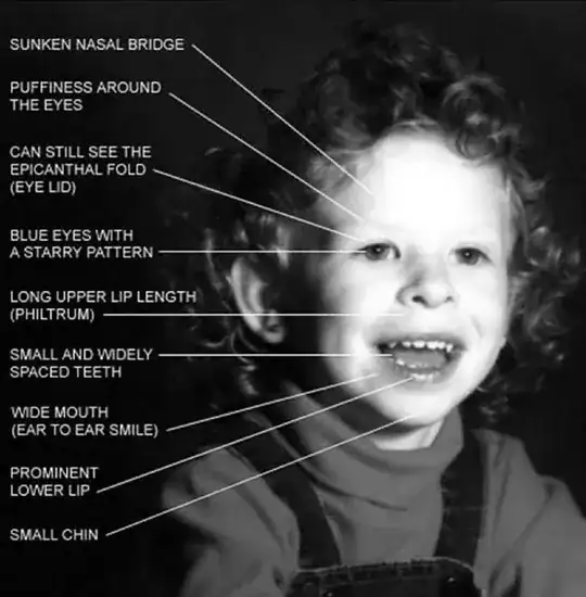 Williams syndrome phenotype